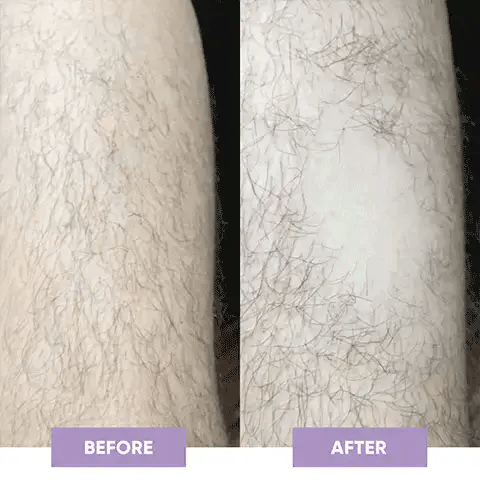 Deji Rechargeable Laser Hair Remover – Smooth Skin in Minutes
