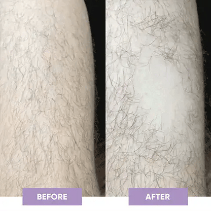 Deji Rechargeable Laser Hair Remover – Smooth Skin in Minutes